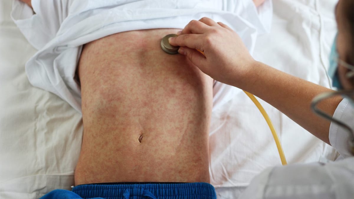 BARMM health ministry declares measles outbreak across region